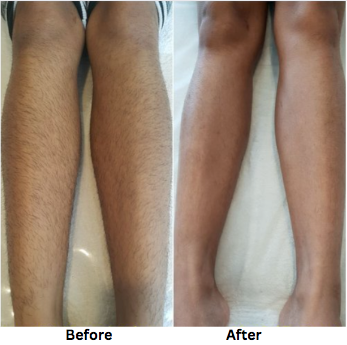 2023 New style in Permanent Hair Removal